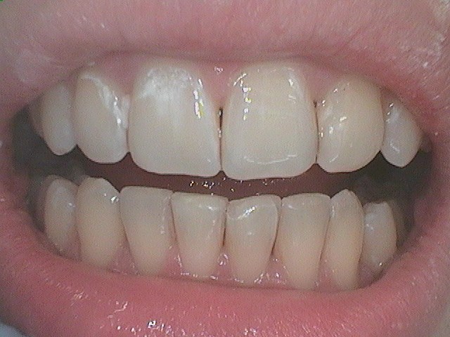 Invisalign from $2,900 in North York