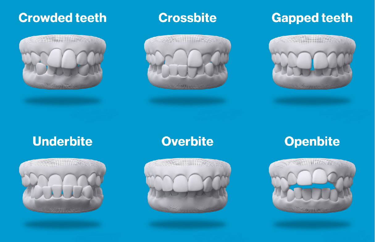 Clear Invisible Braces - Invisalign Clear Braces In North York